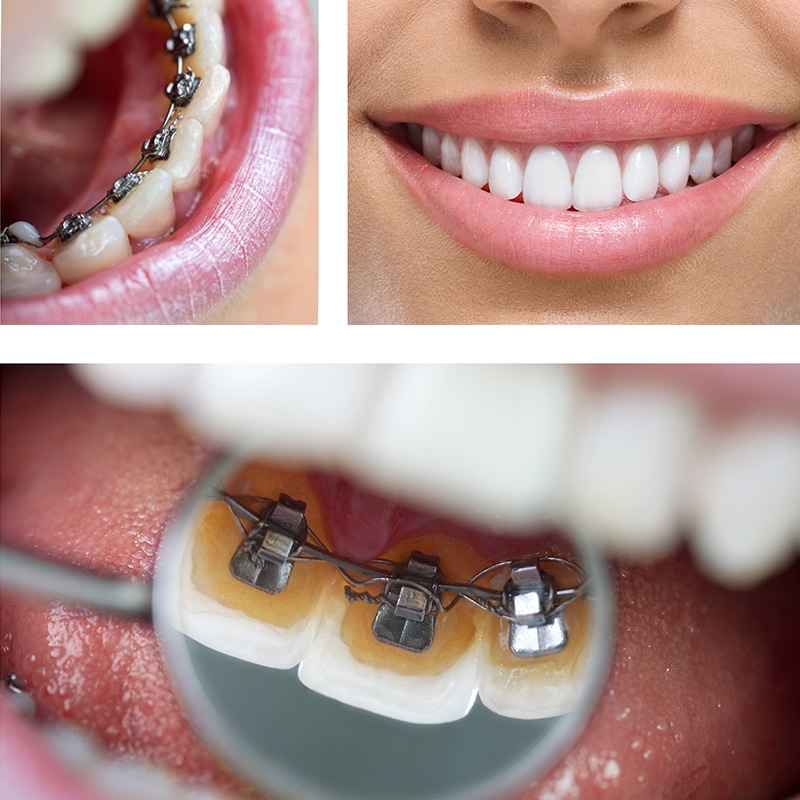 Lingual Braces in Ruislip  Teeth Straightening in Ruislip